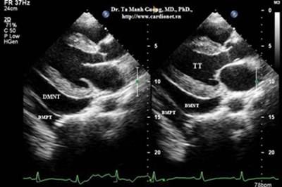 Siêu Doppler trong bệnh lý màng ngoài tim (Full text) - -doppler-trong-benh-ly-mang-ngoai-tim-full-text - -