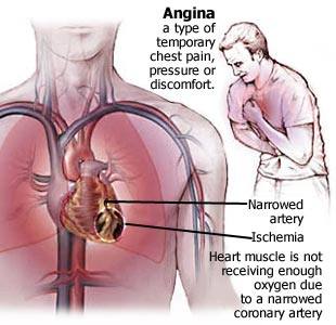 angina.jpg
